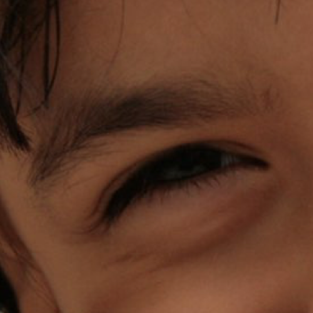 High Blood Pressure and the Eye Dr Rehman Siddiqui