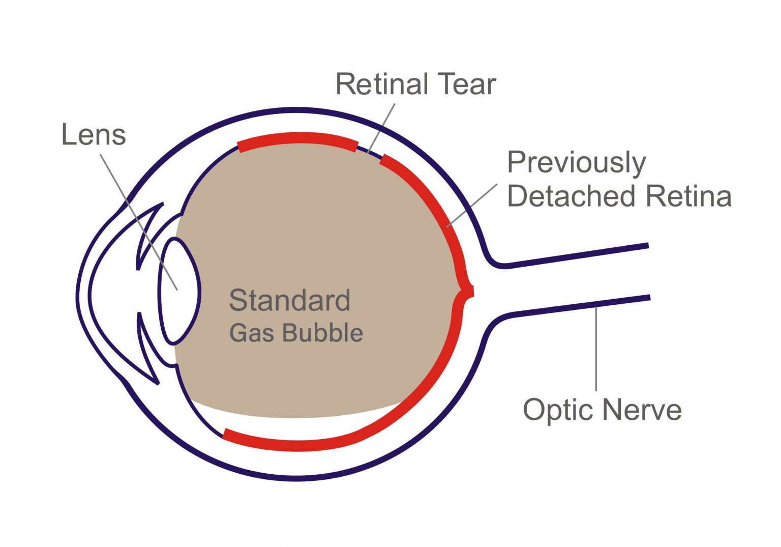 RETINAL DETACHMENT - Dr Rehman Siddiqui