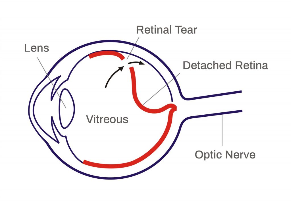 What is Retinal Detachment and How to Treat It