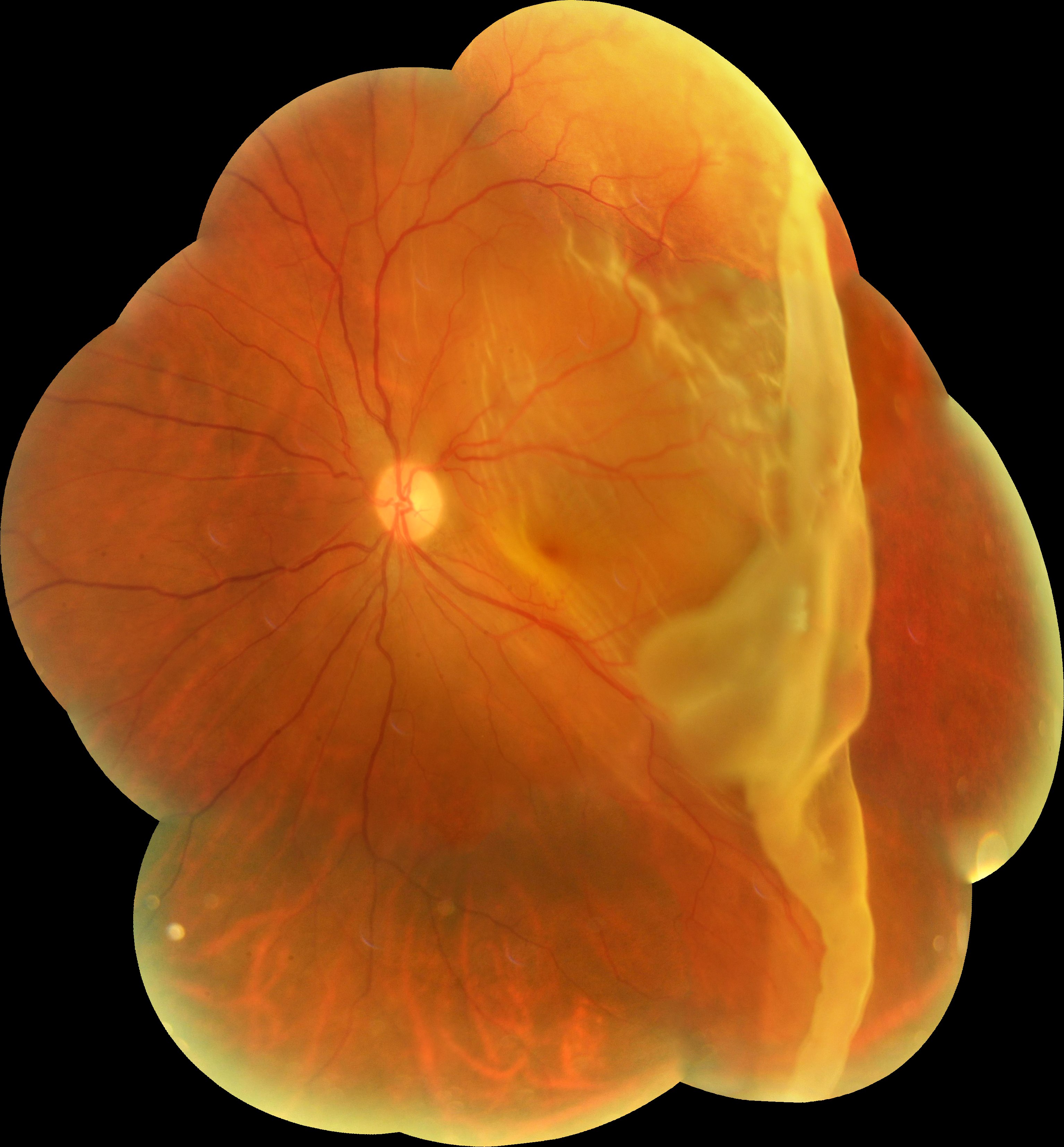 retina detachment