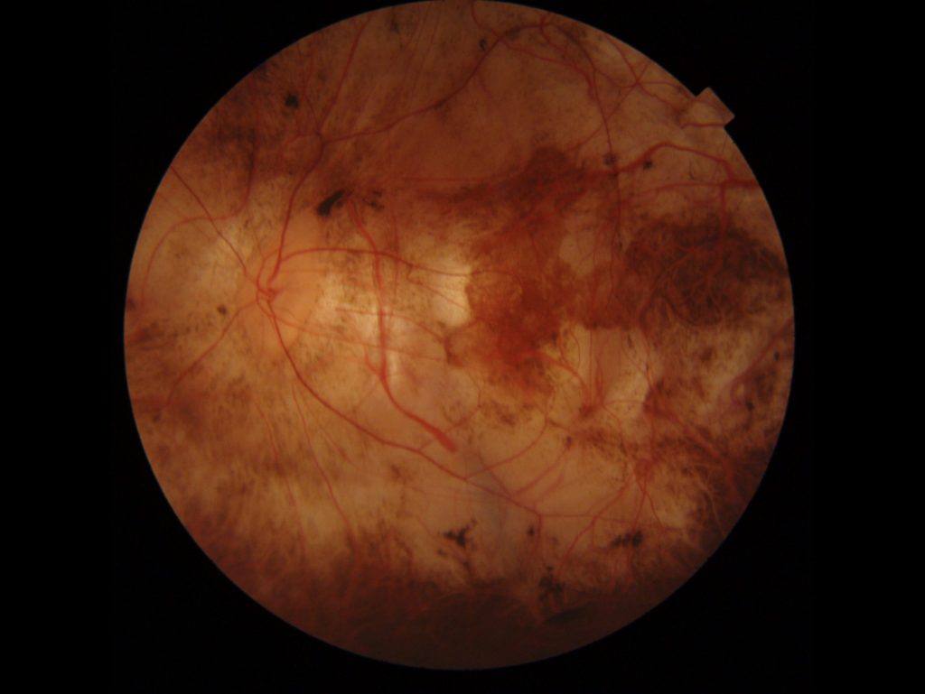 Myopic Macular Degeneration