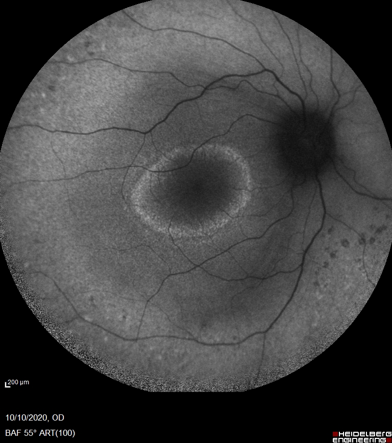Fundus Autofluorescence of a patient with RP