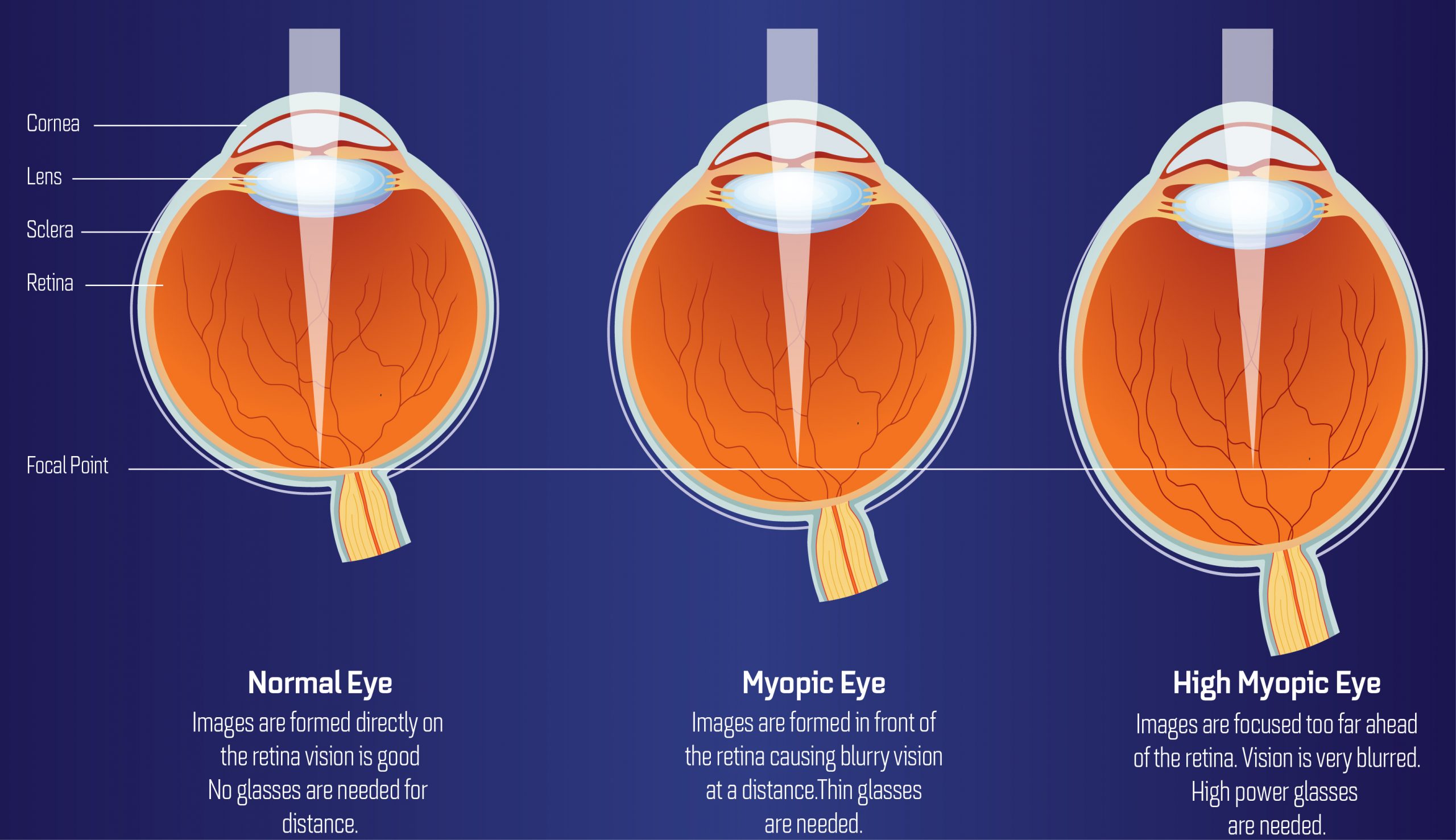 Definition Of Short Sightedness In Biology