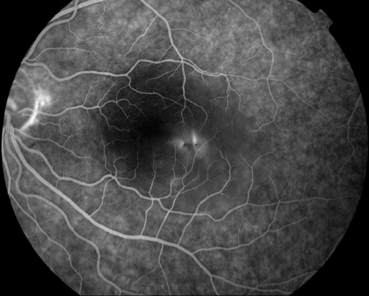 Central Serous Chorioretinopathy (CSR) - Dr Rehman Siddiqui