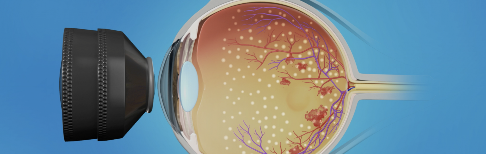 laser-for-diabetic-retinopathy-dr-rehman-siddiqui