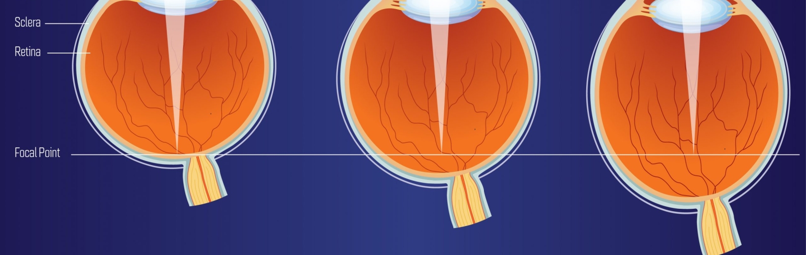 high-myopia-short-sightedness-dr-rehman-siddiqui