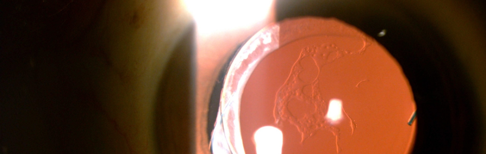 Posterior Capsular Opacification (PCO) Dr Rehman Siddiqui